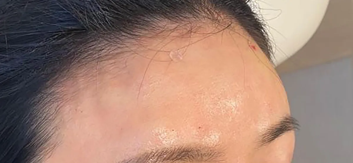 Forehead Hyaluronic Acid After