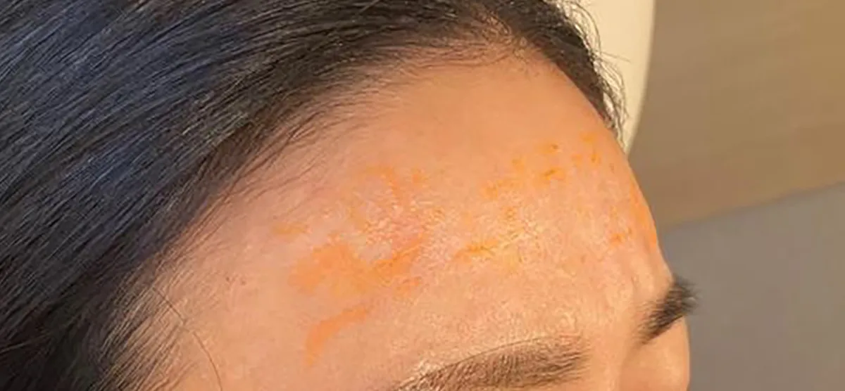 Forehead Hyaluronic Acid Before