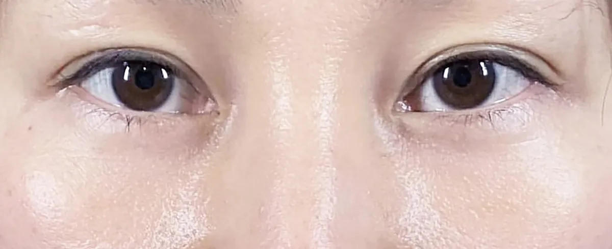 Lower Eyelid Fat Removal Surgery After
