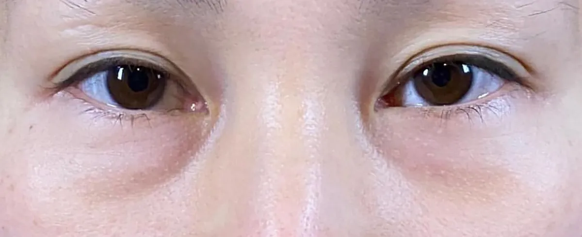 Lower Eyelid Fat Removal Surgery Before