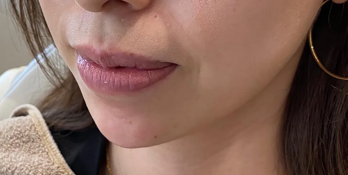 Chin Botox + Chin Filler After