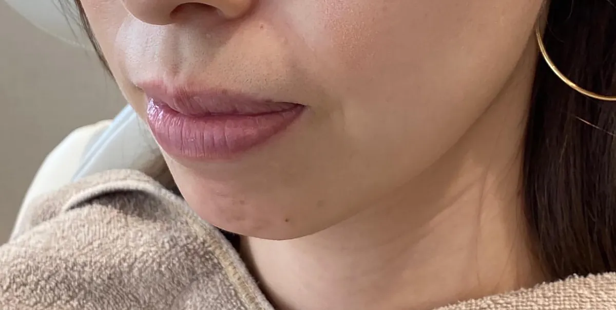 Chin Botox + Chin Filler Before