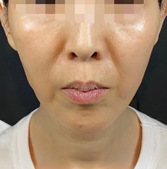 Thermalift (RF + Thread Lift) After