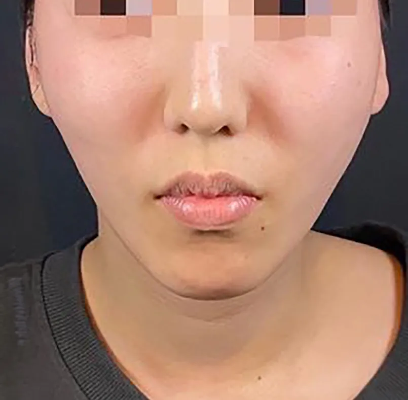 Thermalift (RF + Thread Lift) After