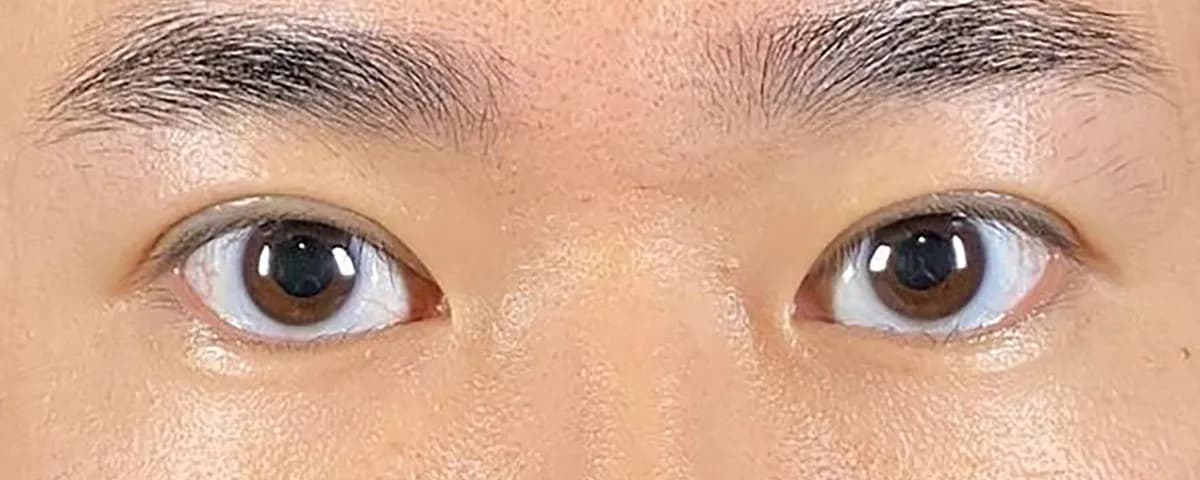 Non-incision Double Eyelid After