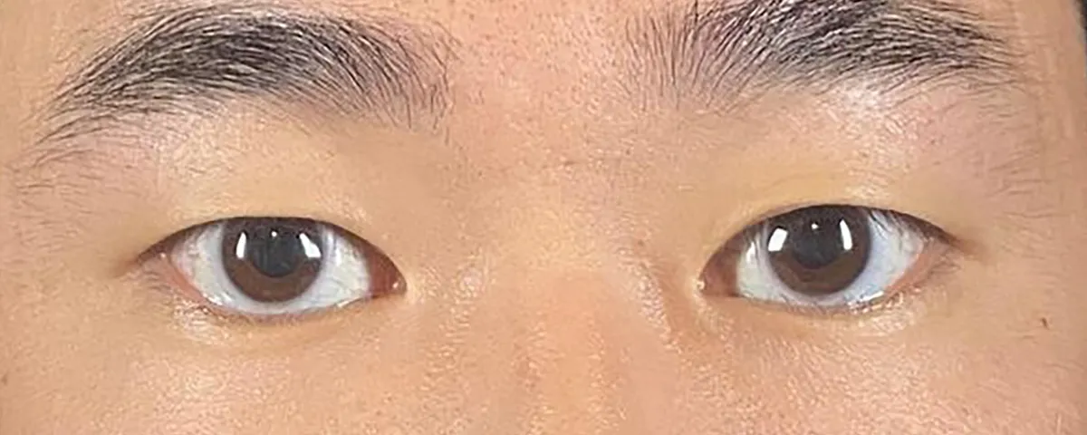 Non-incision Double Eyelid Before