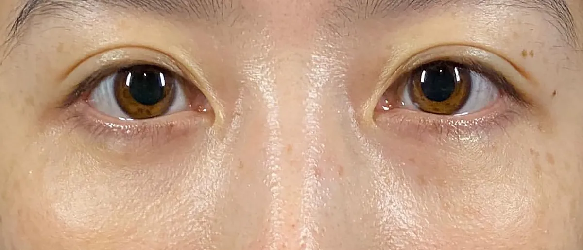 Lower Eyelid Fat Removal Surgery After