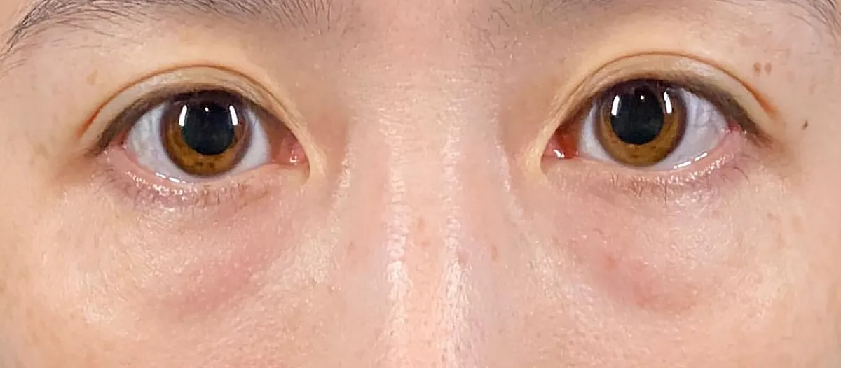 Lower Eyelid Fat Removal Surgery Before