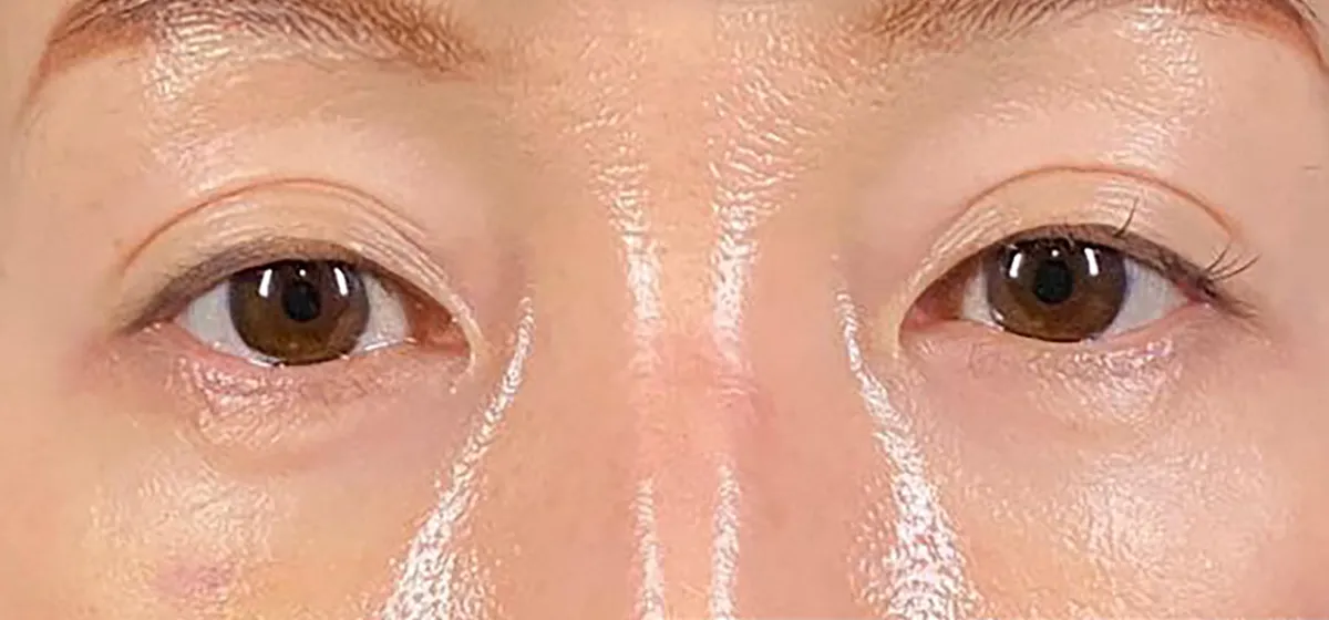 Lower Eyelid Fat Removal Surgery After