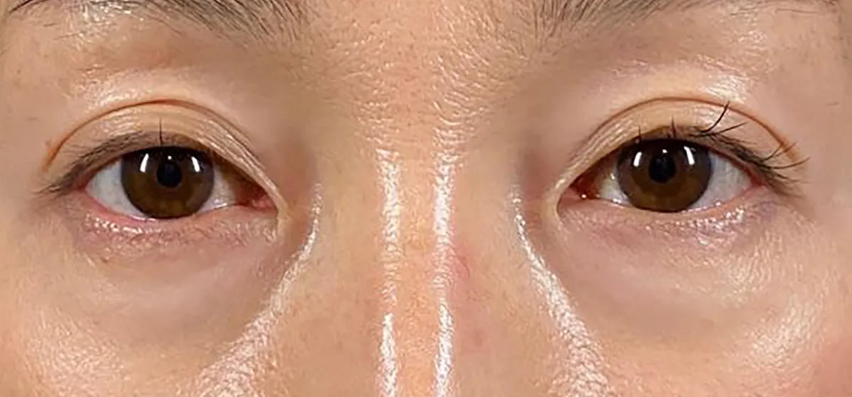 Lower Eyelid Fat Removal Surgery Before