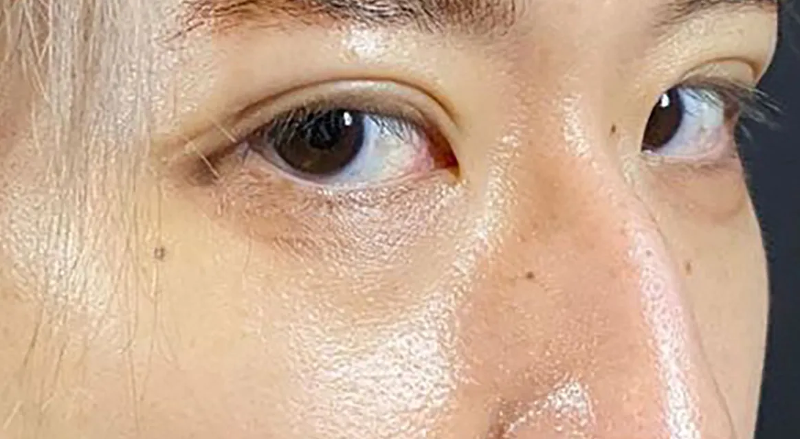 Non-incision Double Eyelid After