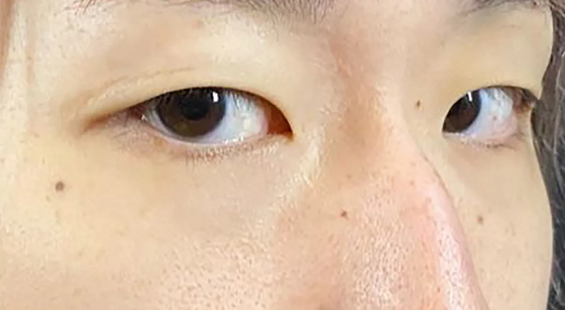Non-incision Double Eyelid Before