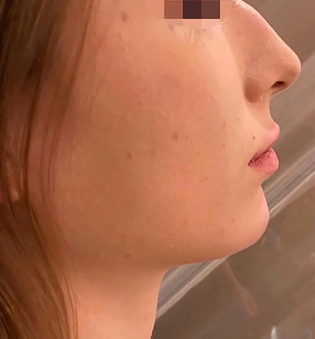 Chin Botox + Chin Filler After