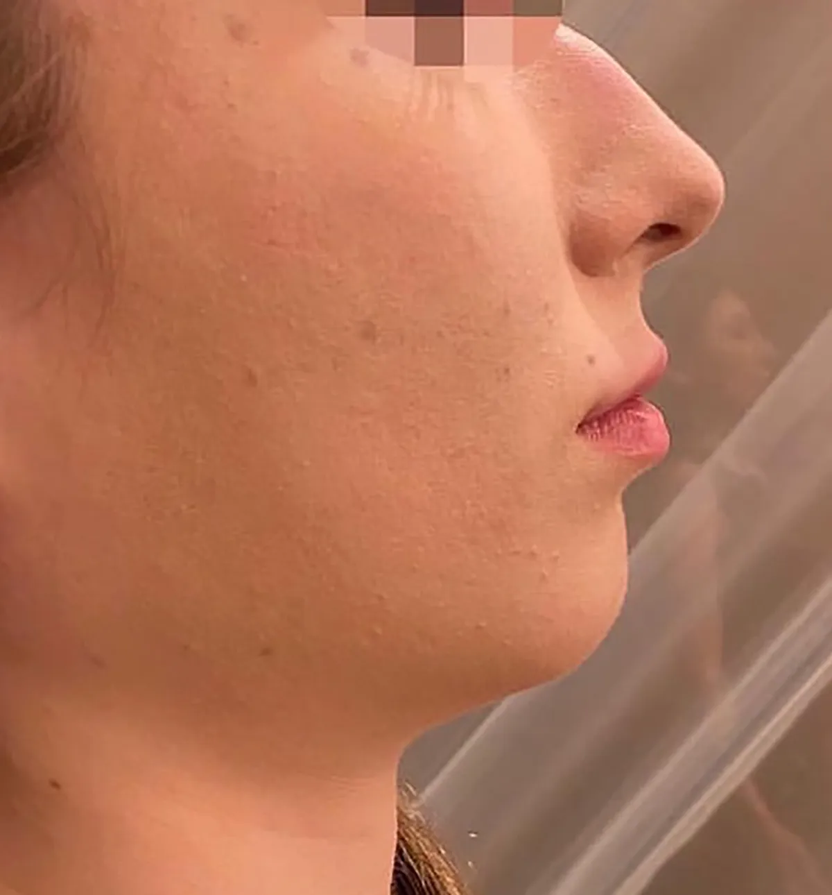 Chin Botox + Chin Filler Before