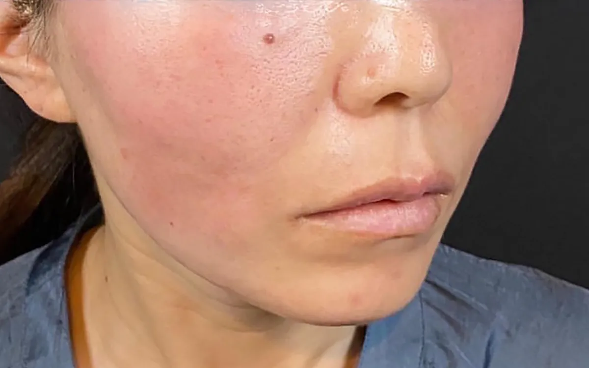 Thermalift (RF + Thread Lift) After