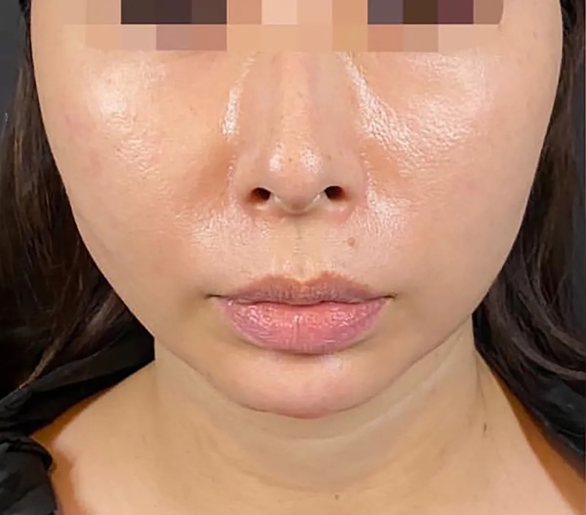 Mix Thread Lift After