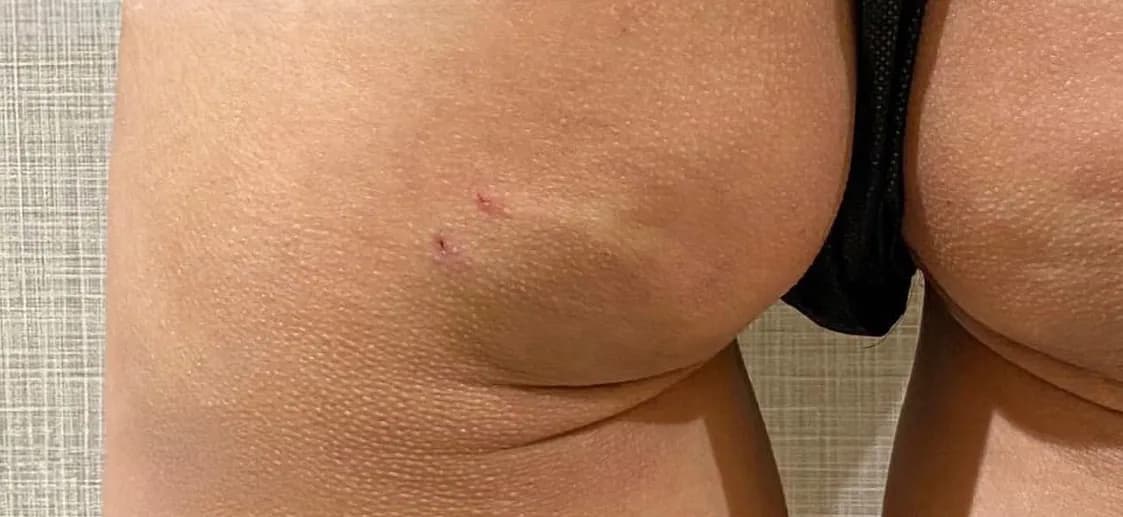 Buttock Augmentation After