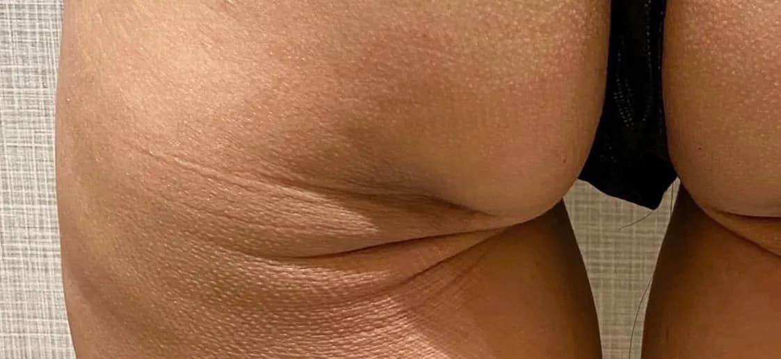 Buttock Augmentation Before