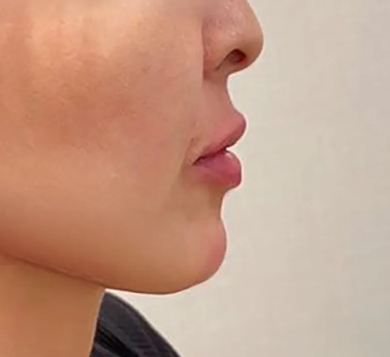 Lips & Chin Hyaluronic Acid Injection After