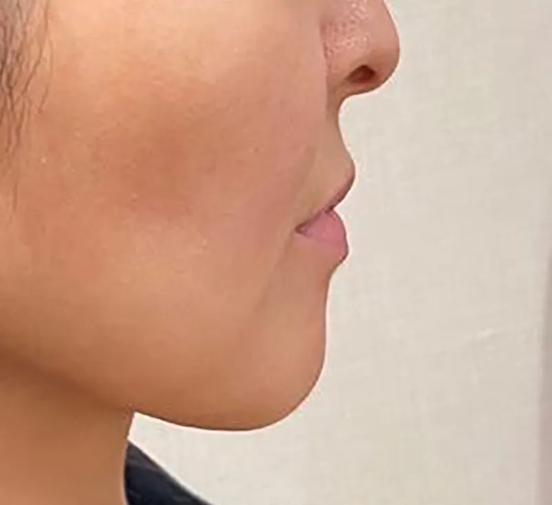 Lips & Chin Hyaluronic Acid Injection Before
