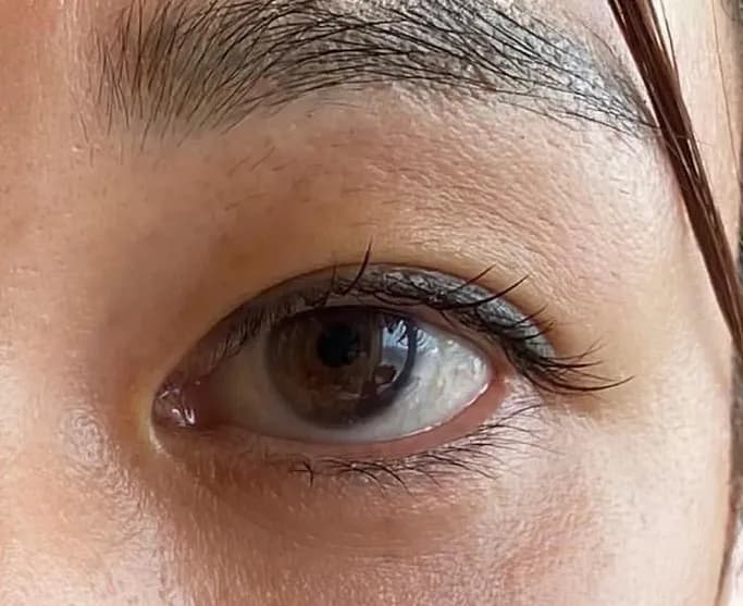 Upper Eyelid Hyaluronic Acid After