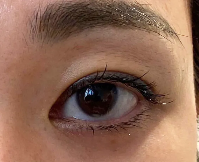 Upper Eyelid Hyaluronic Acid Before