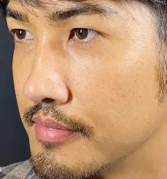 Lower Eyelid Fat Removal Surgery After