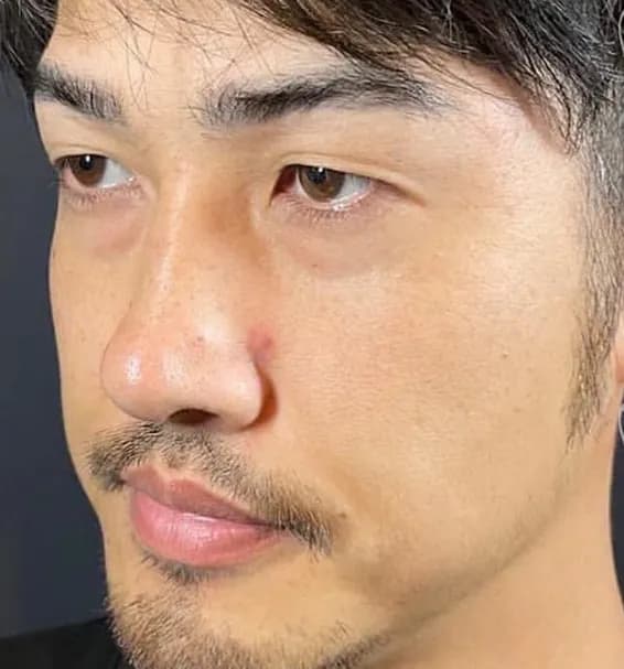 Lower Eyelid Fat Removal Surgery Before