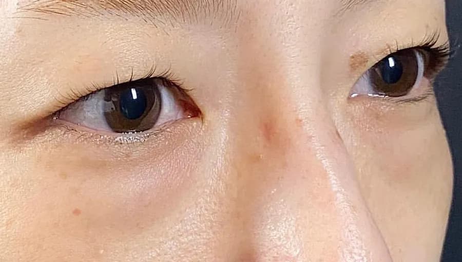 Lower Eyelid Fat Removal Surgery Before