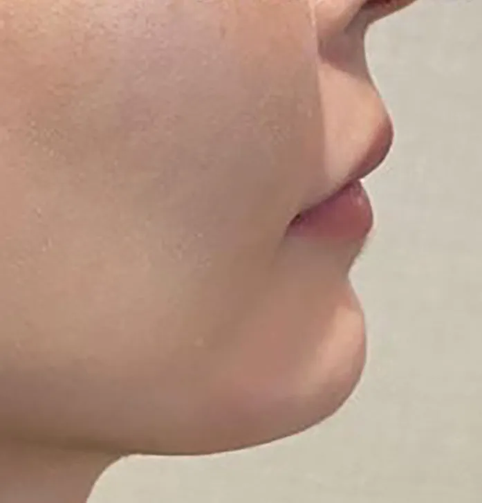 Chin Hyaluronic Acid Injection After