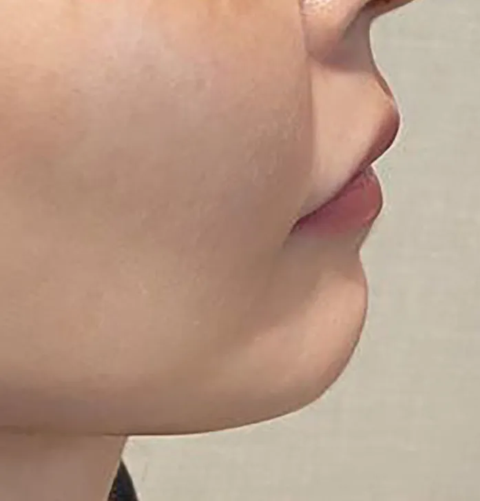 Chin Hyaluronic Acid Injection Before