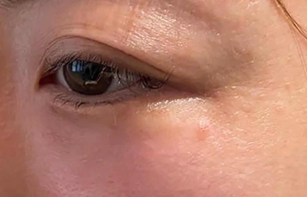 Under-Eye Baby Collagen Injection After