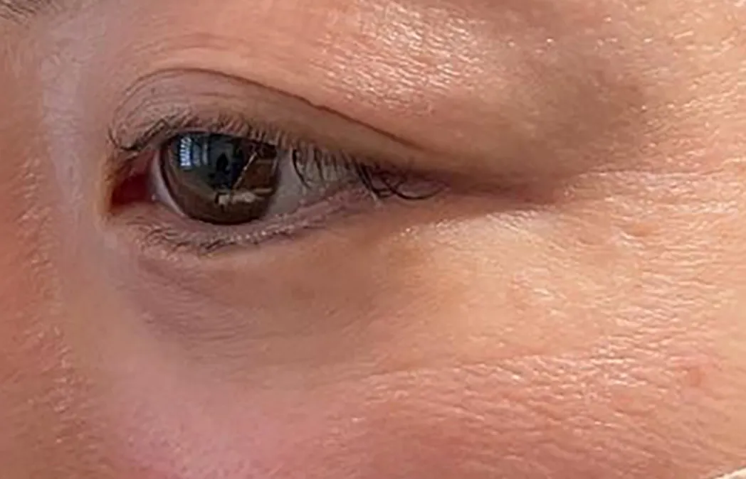 Under-Eye Baby Collagen Injection Before