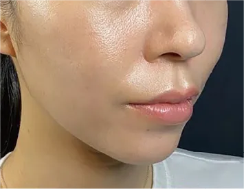 Combination Lift (HIFU + Thread) After