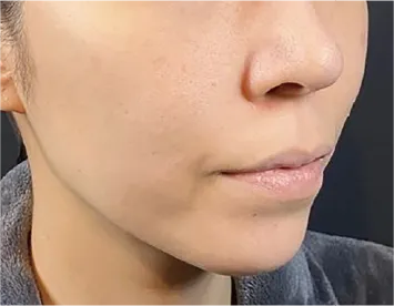 Combination Lift (HIFU + Thread) Before