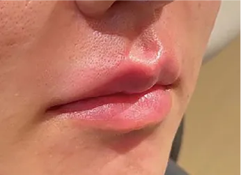 Philtrum Shortening Hyaluronic Acid Injection After