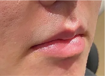 Philtrum Shortening Hyaluronic Acid Injection Before