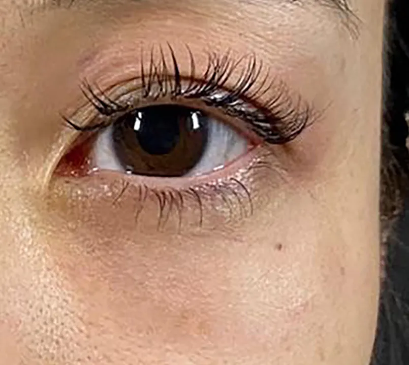 Lower Eyelid Fat Removal Surgery After