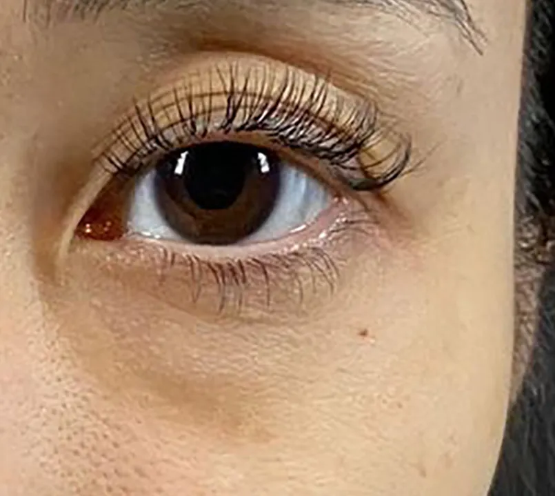 Lower Eyelid Fat Removal Surgery Before