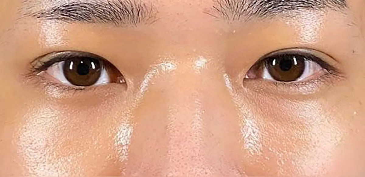 Non-incision Double Eyelid After