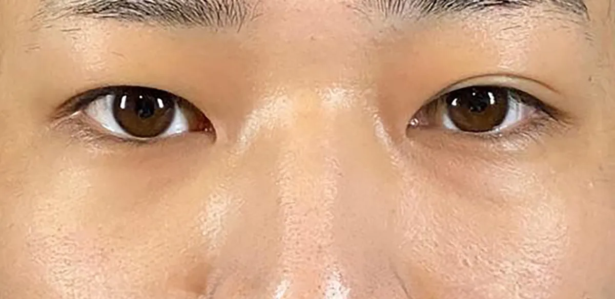Non-incision Double Eyelid Before