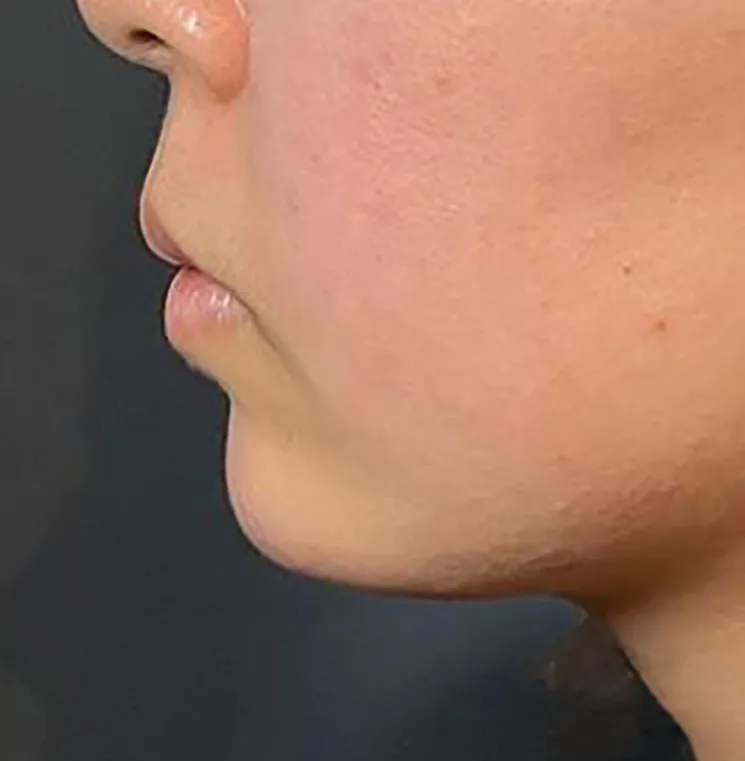 Chin Hyaluronic Acid Injection After