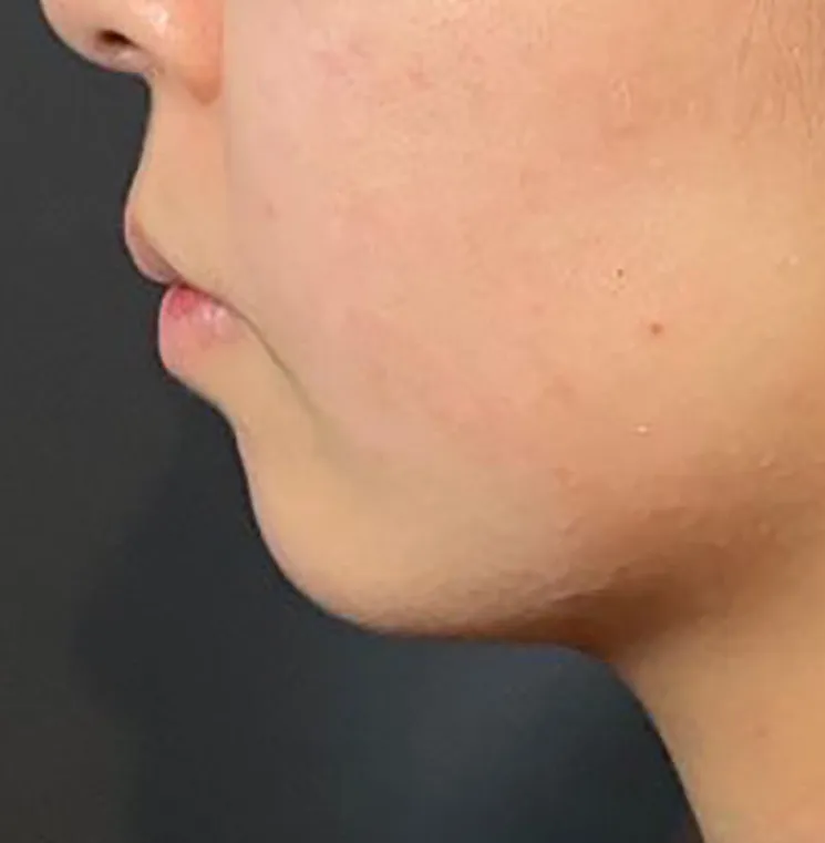Chin Hyaluronic Acid Injection Before
