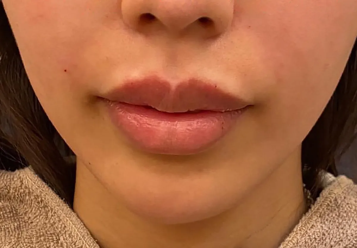 Nasolabial FoldsHyaluronic Acid Injection After