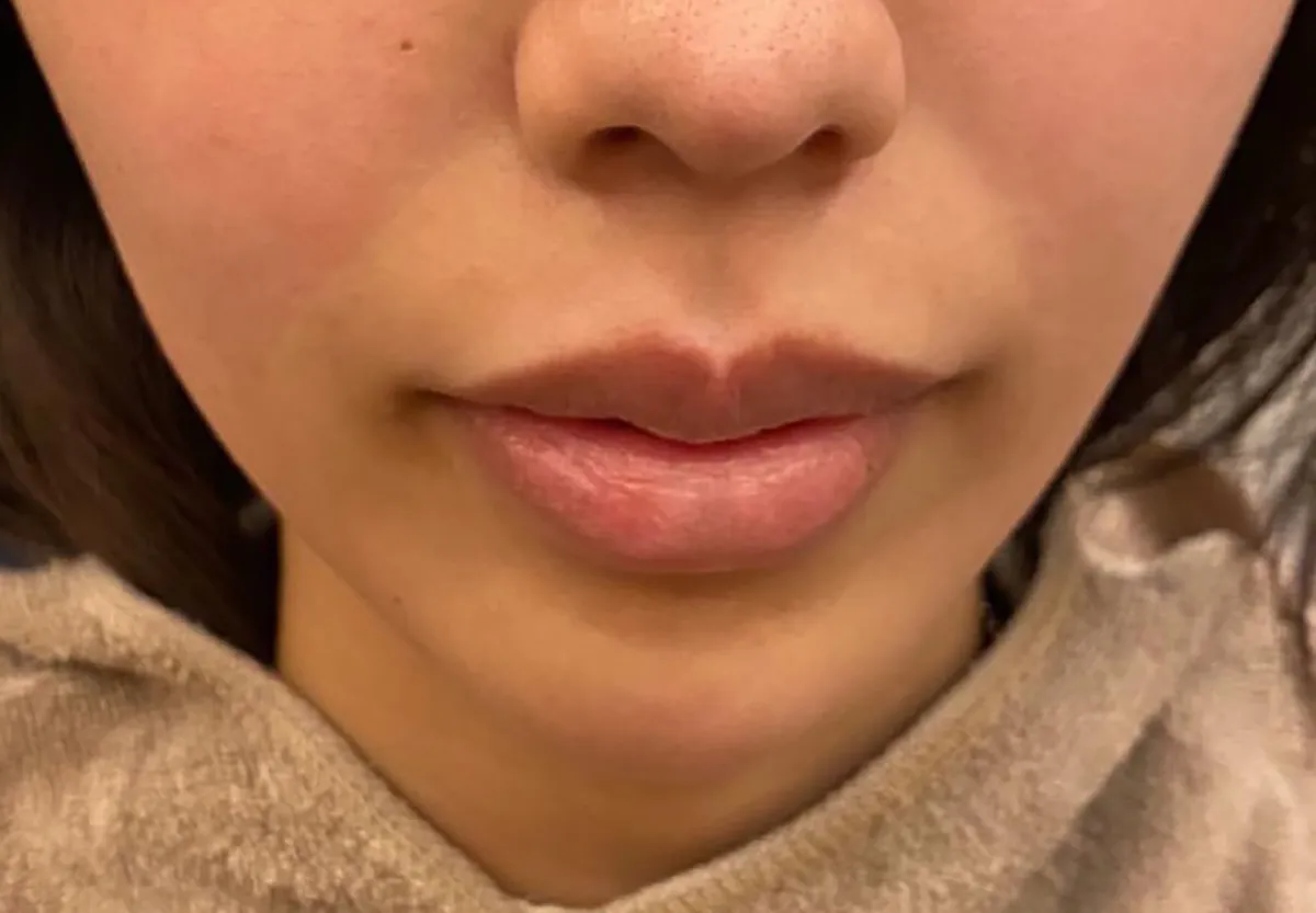 Nasolabial FoldsHyaluronic Acid Injection Before