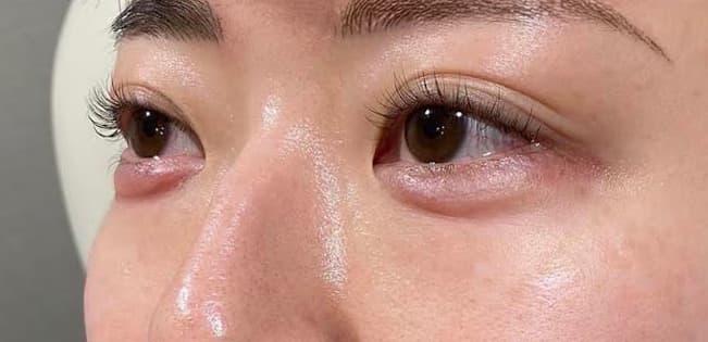 Tear Trough Hyaluronic Acid After