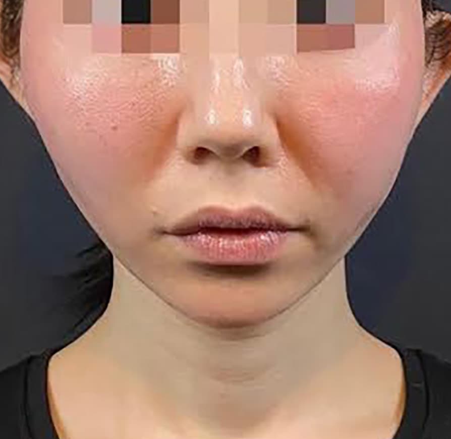HIFU, Thread Lift After