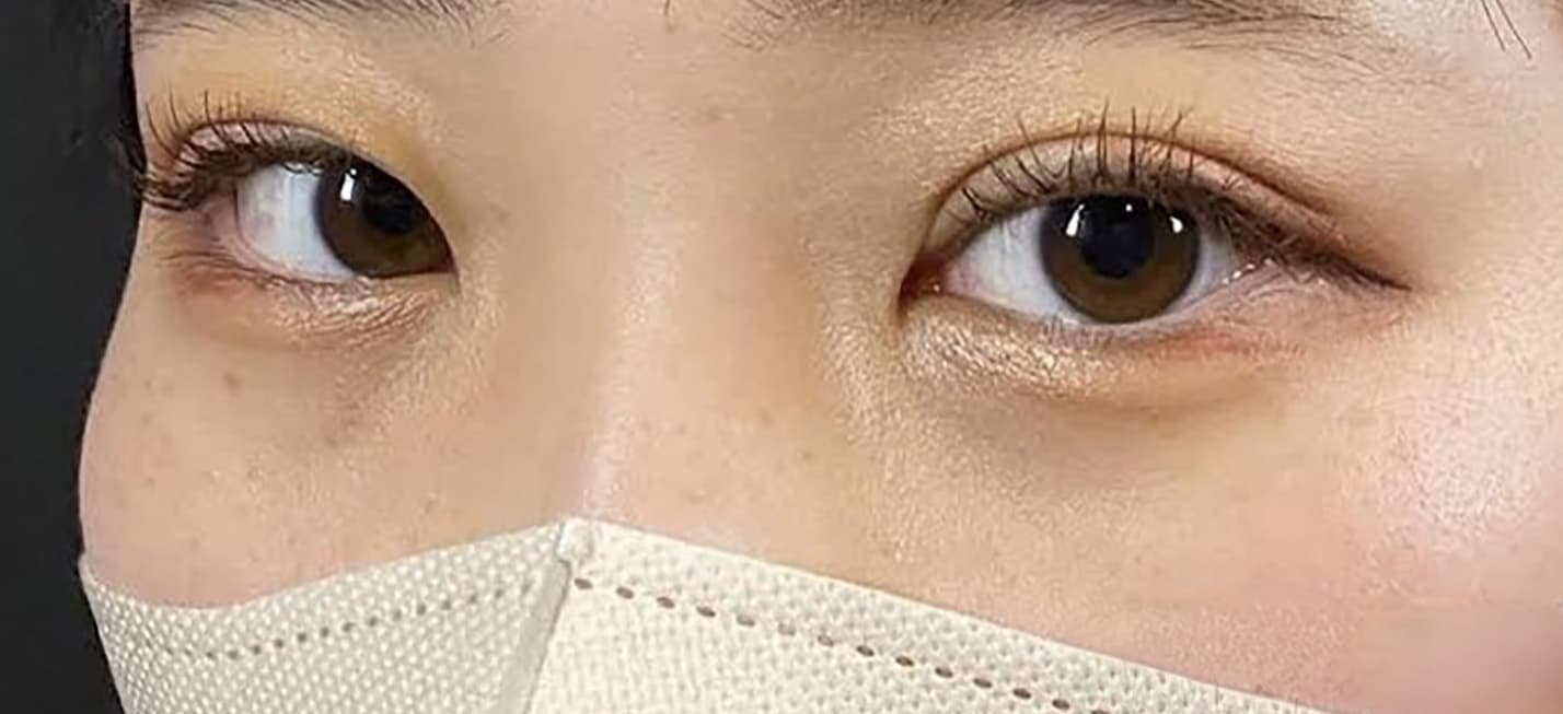 Rejuva Eyes Double (Eyelid) After
