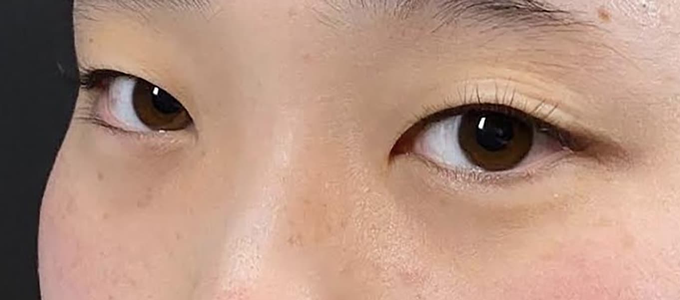 Rejuva Eyes Double (Eyelid) Before