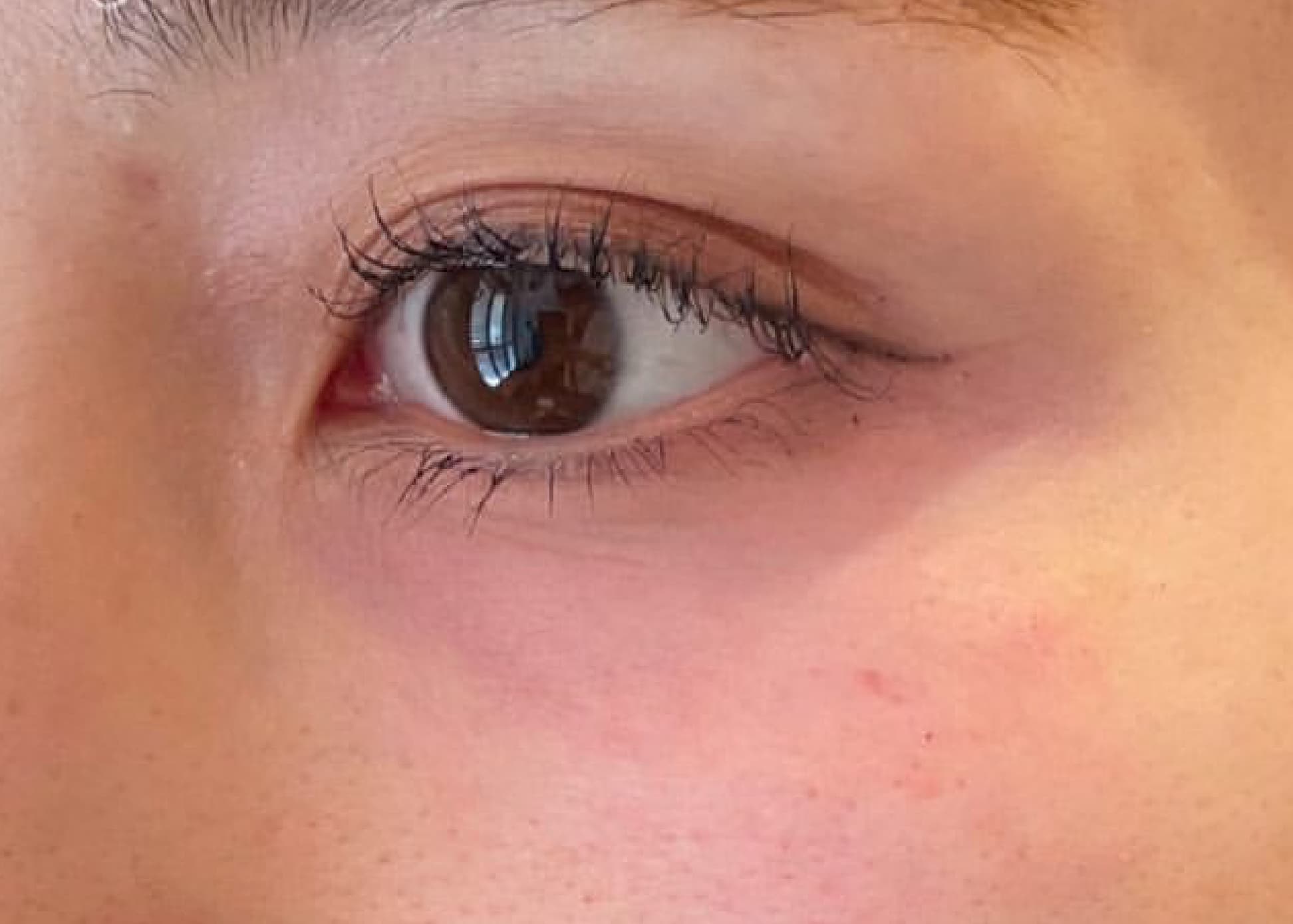 Baby Collagen Injection After